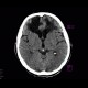 Postischemic changes in frontal lobes: CT - Computed tomography